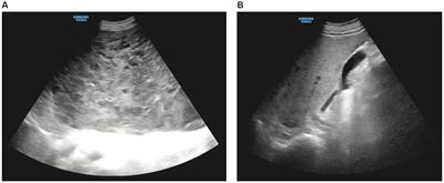 Adult diffuse hepatic hemangiomatosis lesion occupying the entire abdominal and pelvic cavities: a case report